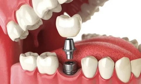 How Do Dentists Decide If You Need Bone Grafting for Dental Implants in Islamabad?